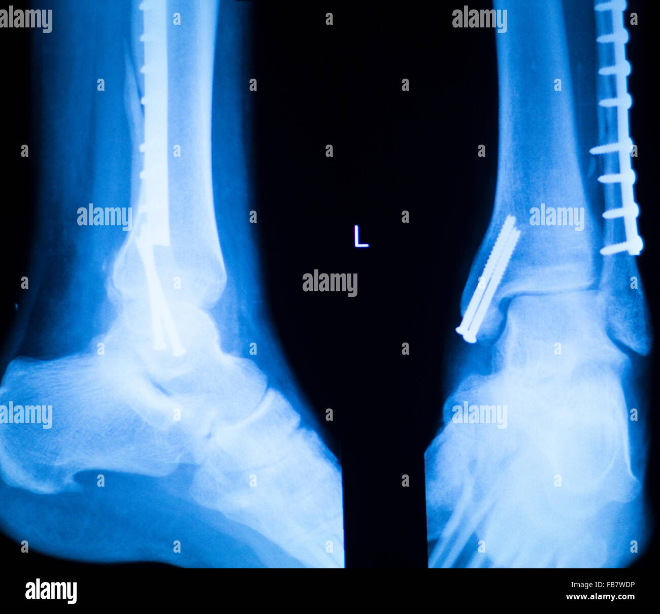 Cheville pied et tibia orthopédie x-ray résultats de scan montrant la  traumatologie plaque et vis implants en titane Photo Stock - Alamy