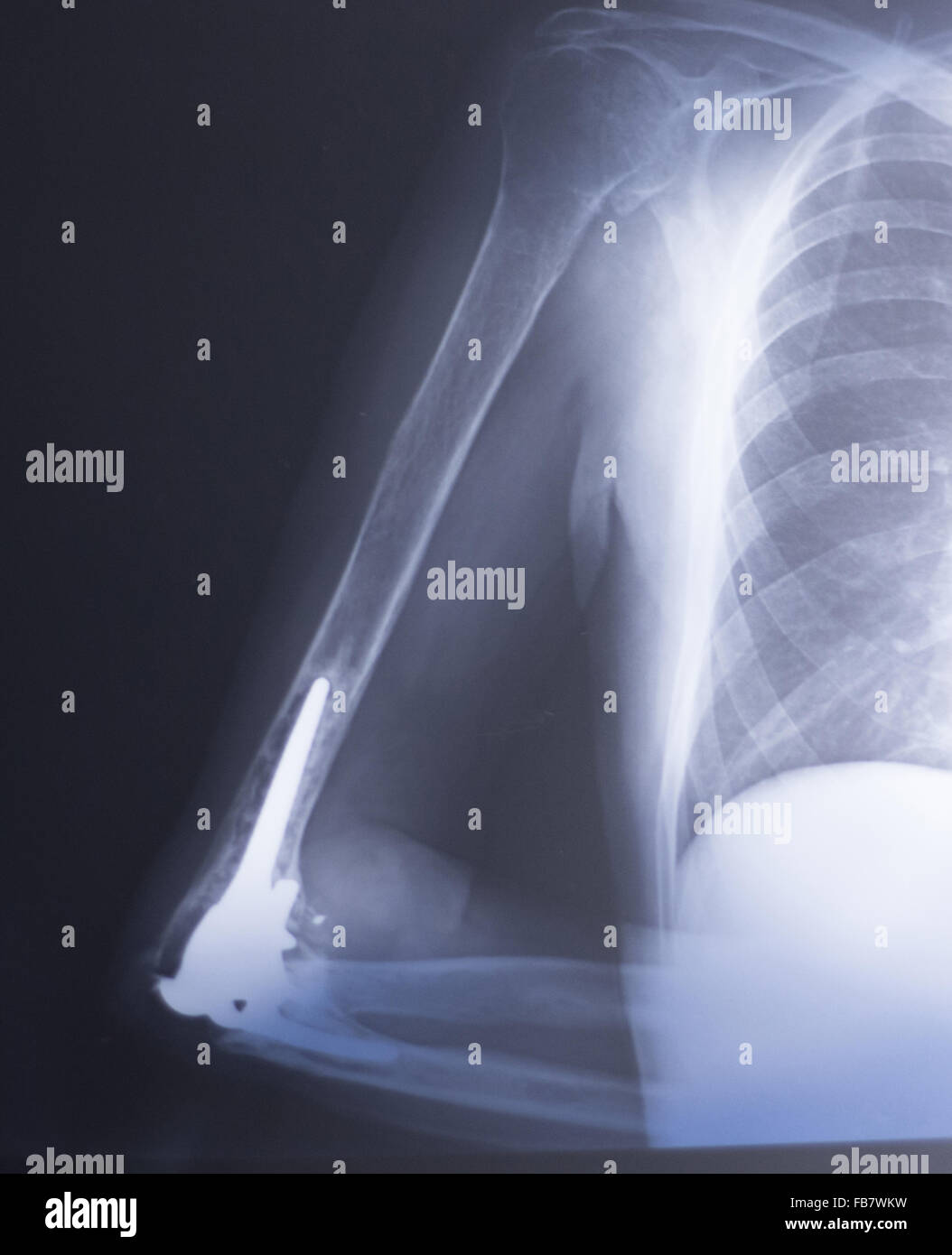 Othopedics et traumatologie implant chirurgical et le coude du bras de xray test d'acquisition des résultats montrant la plaque de métal et des vis en titane. Banque D'Images