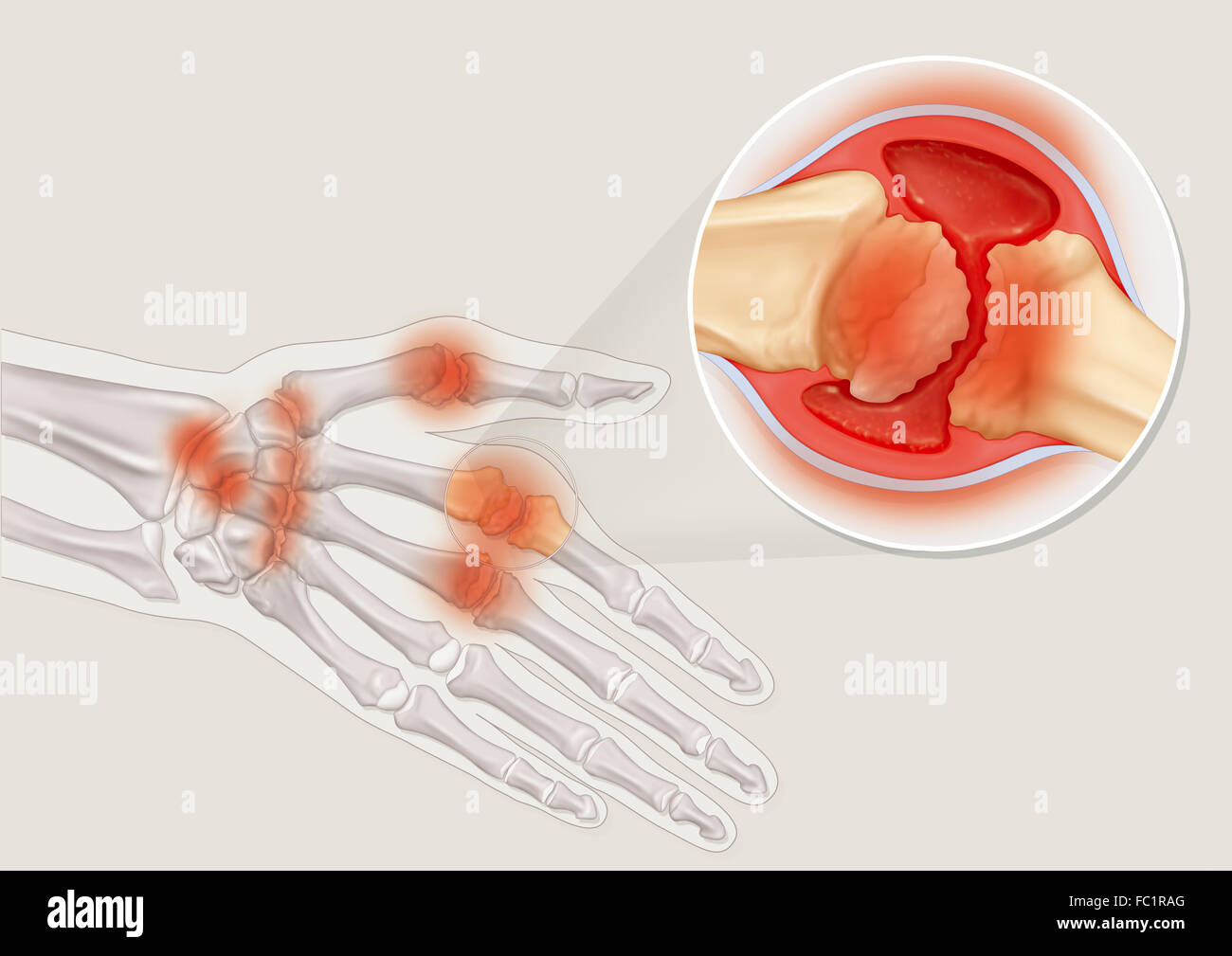 L'arthrite rhumatoïde, l'ENCOMBREMENT Banque D'Images