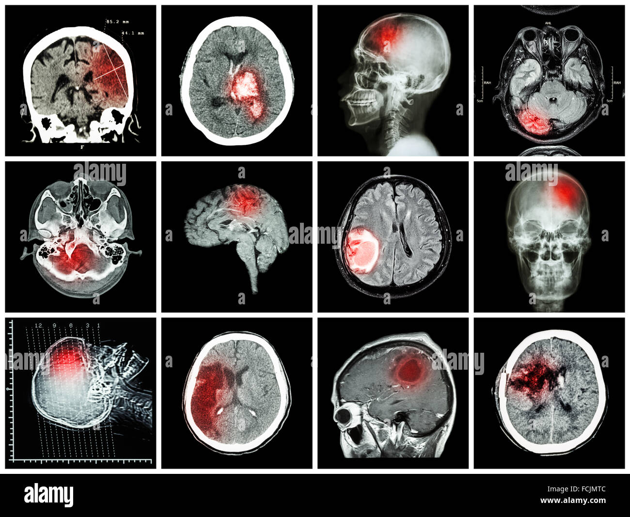 Collection de maladies du cerveau ( CT scan et irm de cerveau : afficher d'infarctus cérébral , l'hémorragie intracérébrale , tumeur au cerveau basal , Banque D'Images