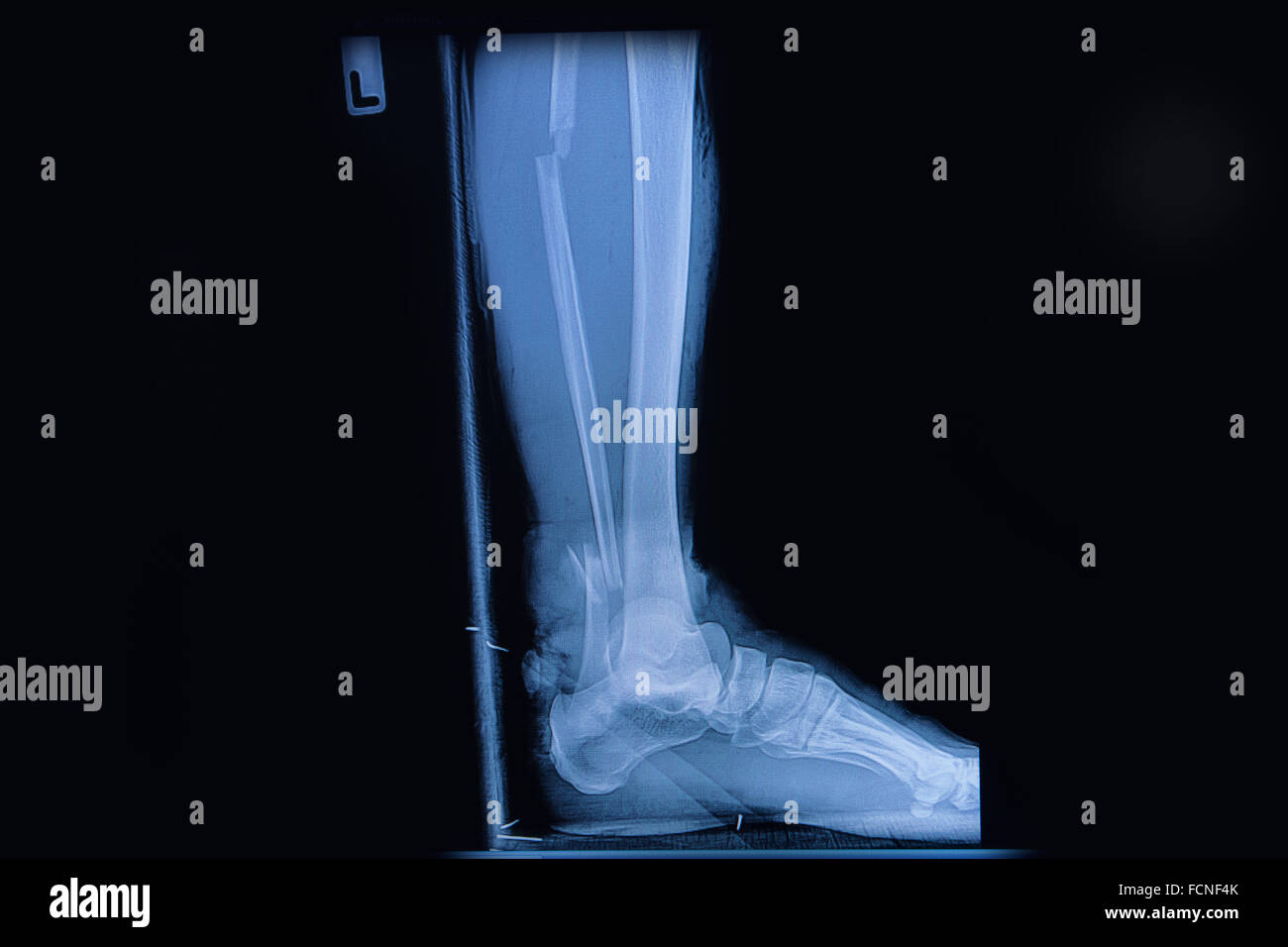 Fracture de la partie inférieure du péroné, sagittale vue Xray Photo Stock Alamy