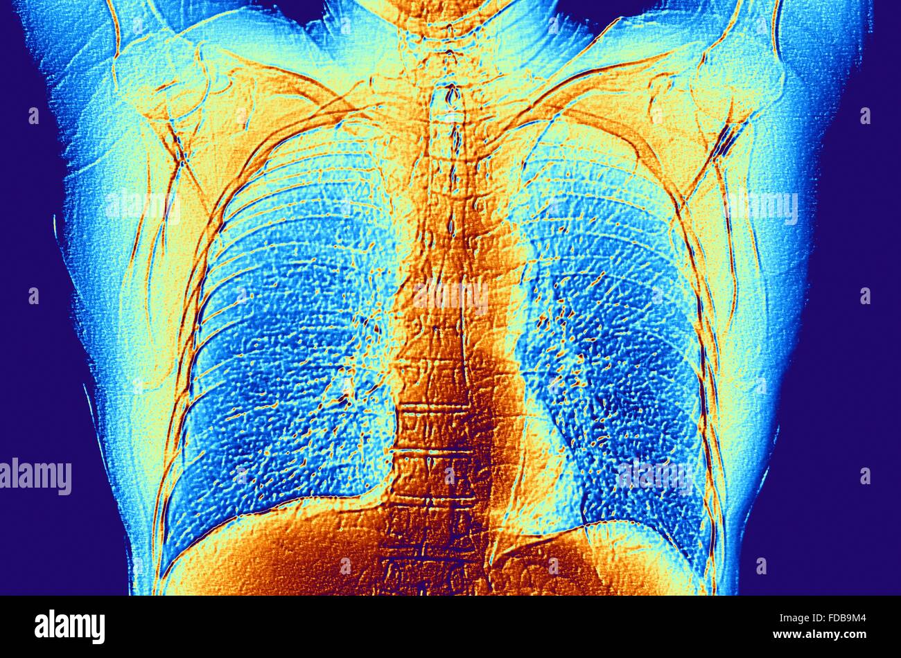 Le cœur et les poumons. Faux-color scanner de la poitrine d'un adulte en bonne santé, montrant les poumons normaux. Banque D'Images