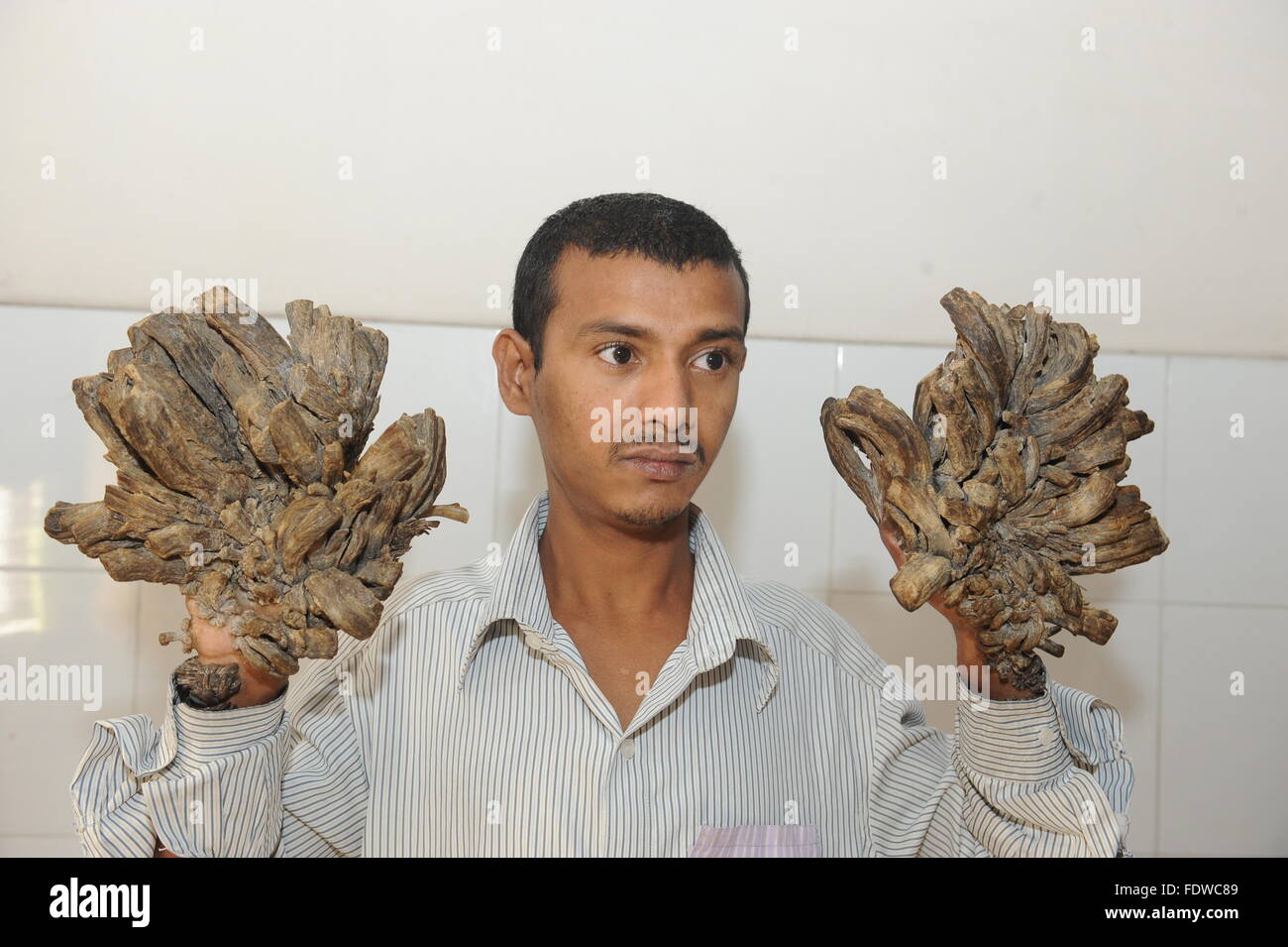 Dhaka, Bangladesh. 2 Février, 2016. Vajondar Abul, un patient atteint d'épidermodysplasie verruciforme, une rare maladie de peau, traitement attend au Dhaka Medical College Hospital à Dhaka, Bangladesh, 02 février 2016. Vajondar l'Abul a été souffrance écorce-comme des verrues sur les mains et les pieds depuis quatre ans. L'homme avec sa femme et une fille vivent dans le district sud de Khuna. Zakir Hossain Chowdhury Crédit : zakir/Alamy Live News Banque D'Images