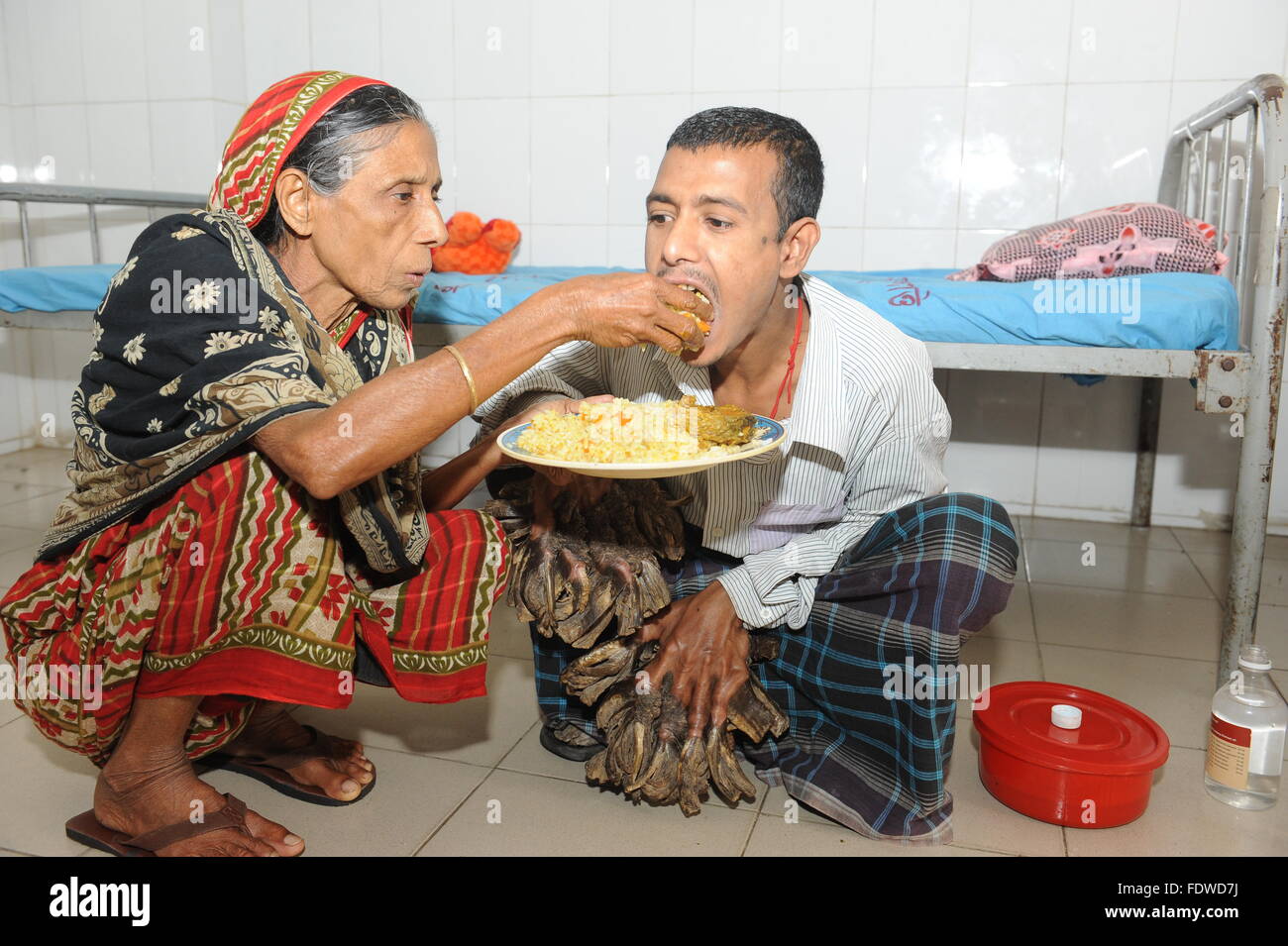 Dhaka, Bangladesh. 2 Février, 2016. Vajondar Abul, un patient atteint d'épidermodysplasie verruciforme, une rare maladie de peau, déjeune en prenant l'aide de sa mère en tant qu'il attend d'un traitement à la Dhaka Medical College Hospital à Dhaka, Bangladesh, 02 février 2016. Vajondar l'Abul a été souffrance écorce-comme des verrues sur les mains et les pieds depuis quatre ans. L'homme avec sa femme et une fille vivent dans le district sud de Khuna. Zakir Hossain Chowdhury Crédit : zakir/Alamy Live News Banque D'Images