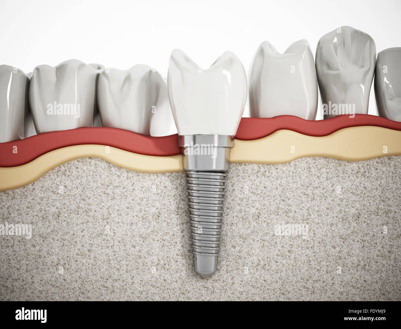 Illustration de dents montrant la structure d'implant dentaire Banque D'Images