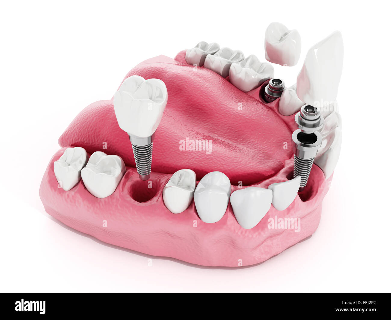 Illustration de dents montrant la structure d'implant dentaire Banque D'Images