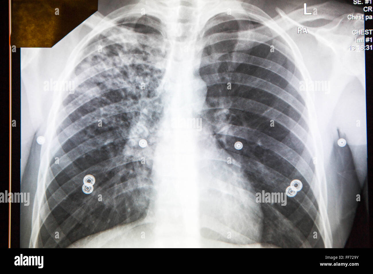 Un résultat anormal à la radiographie numérique est affiché sur l'écran dans le NHS's Mobile X-ray Unit (MXU). La radiographie pulmonaire a été considérée comme un service de santé publique le dépistage de la tuberculose (TB). Le véhicule est garé à l'extérieur d'une auberge dans le centre de Londres et la visite fait partie d'une intervention de santé publique pour la recherche active des cas de tuberculose dans des groupes difficiles à atteindre. Le taux de tuberculose dans Londres sont plus élevés que dans toute autre capitale européenne de l'ouest et est un problème majeur de santé publique. La tuberculose est une maladie infectieuse, mais traitable et curable s'il est diagnostiqué à temps. Le diagnostic précoce est un élément clé de la lutte contre la tuberculose et la recherche active des cas est un imp Banque D'Images