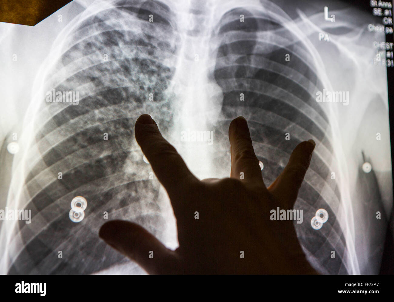 Radiographie thoracique anormale Banque de photographies et d'images à  haute résolution - Alamy