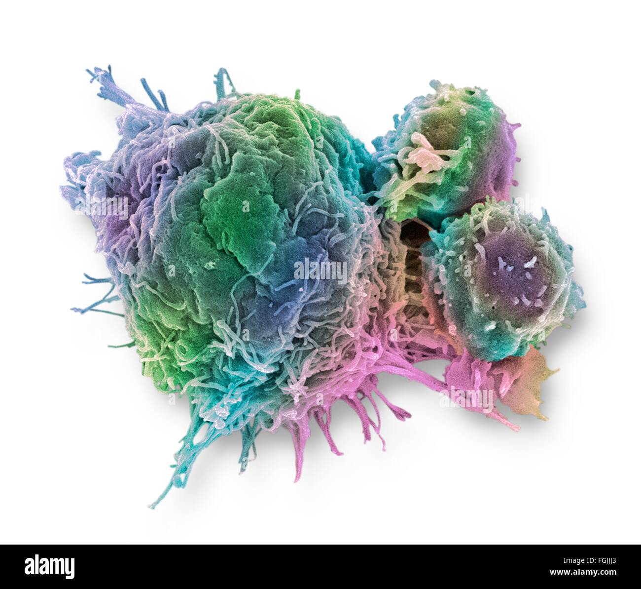 Les lymphocytes T et les cellules du cancer. Couleur de l'analyse des électrons Microphotographie (SEM) de cellules lymphocytes T (cellules rondes plus petites) Banque D'Images