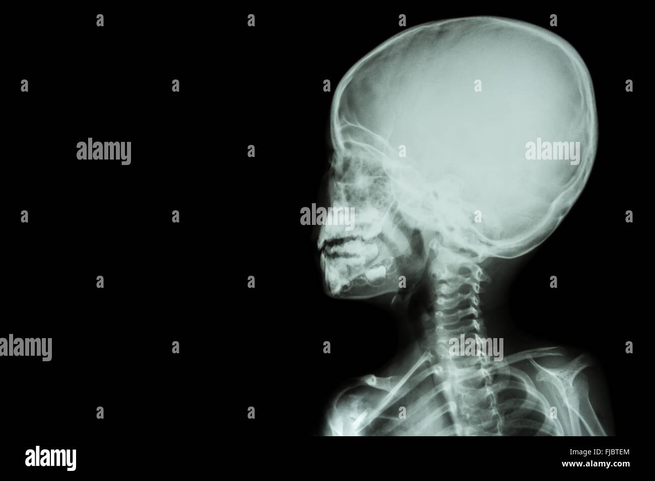 Film x-ray le crâne et corps d'enfant ( zone vide du côté gauche ) Banque D'Images