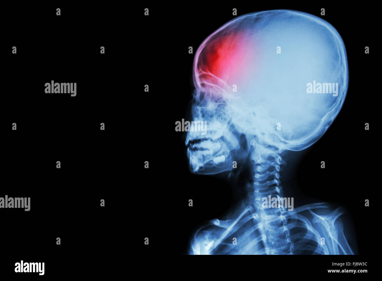 Film x-ray corps d'enfant et des maux de tête ( maladie du cerveau ) ( ) isolé Banque D'Images