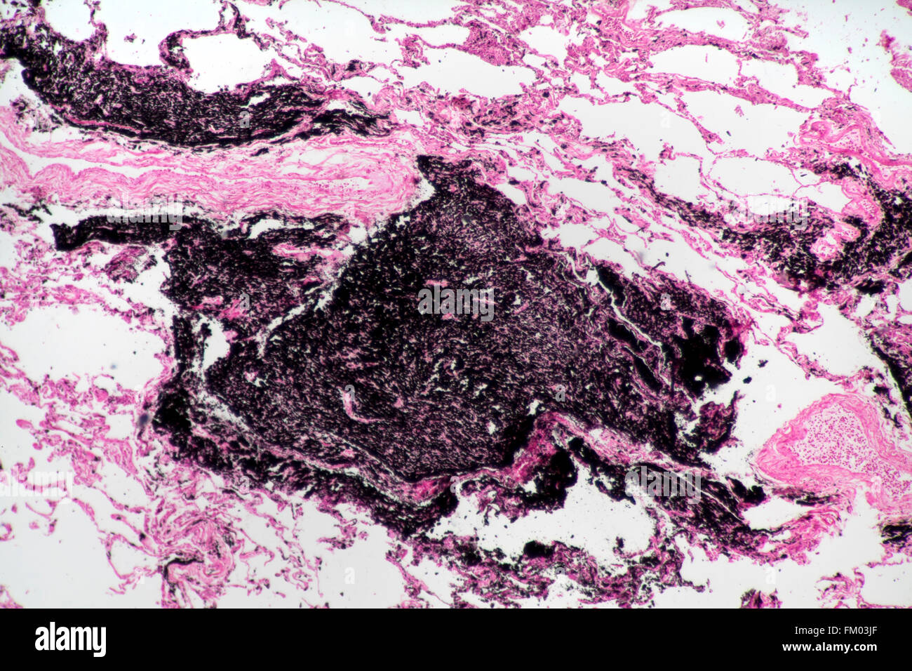 La section des poumons carbonisés montrant les dépôts, fond clair photomicrographie Banque D'Images