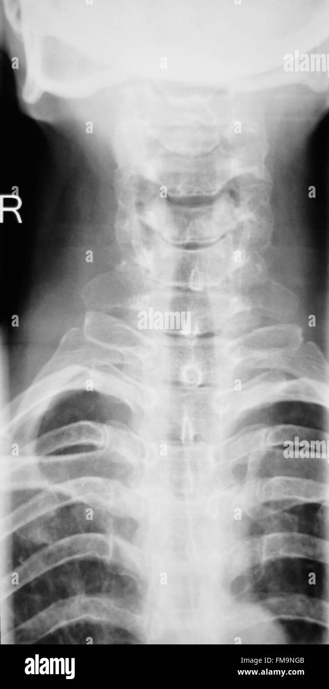 Crâne, cou, dos, vertèbre et épaules dommage radiographie médicale, test d'acquisition de l'image. Banque D'Images