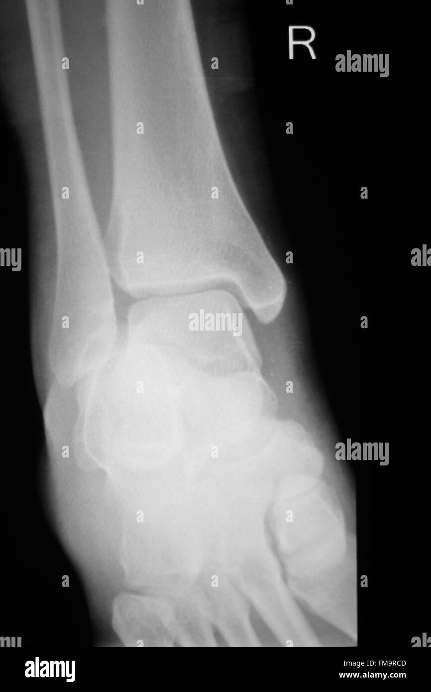 Shin, la partie inférieure de la jambe et de la cheville traumatologie blessures orthopédiques des rayons x test d'acquisition de l'image. Banque D'Images