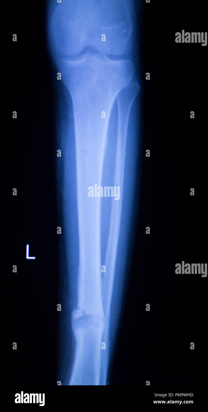 L'avant-bras, bras et blessure au coude xray scan test résultats pour  diagnostiquer la source de la douleur Photo Stock - Alamy