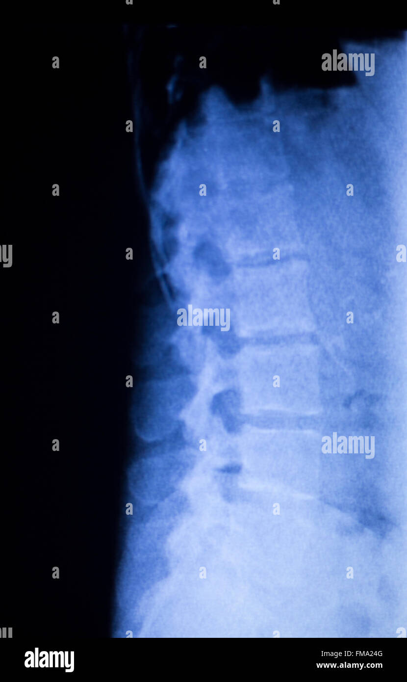 La colonne vertébrale, douleurs de dos et cou orthopaedic xray scan