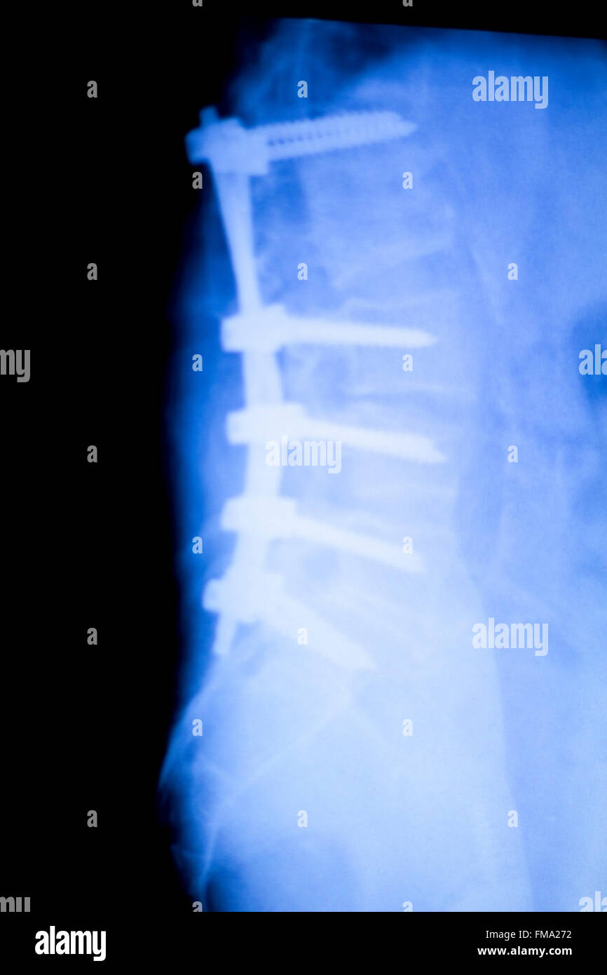 La colonne vertébrale, du dos et du cou métal titane orthopédiques Plaque  renfort et spinal implant vis xray scanner les résultats de tests Photo  Stock - Alamy