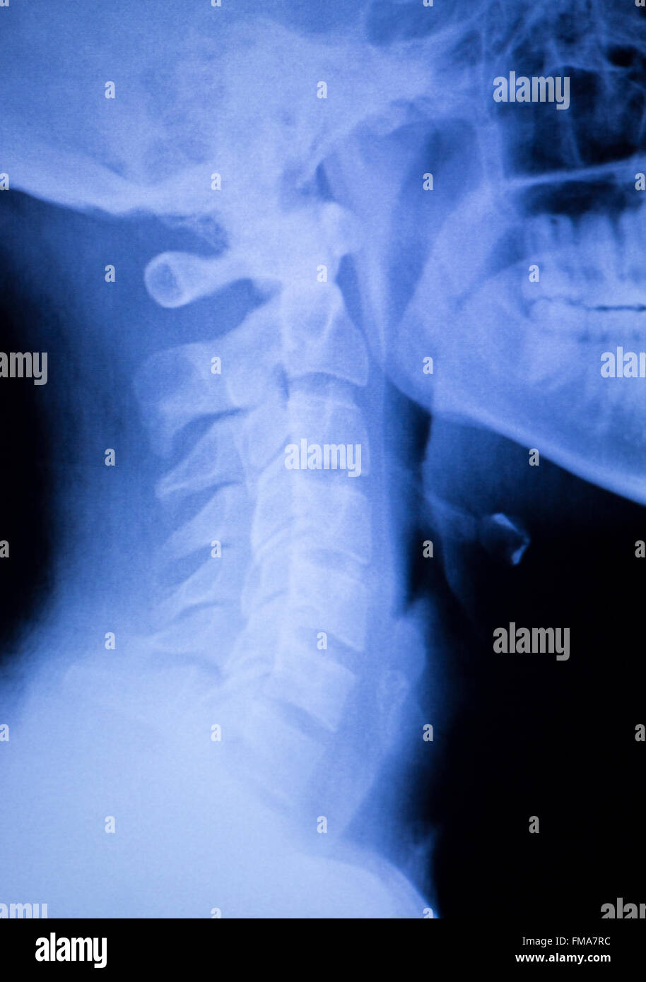 La colonne vertébrale, douleurs de dos et cou orthopaedic xray scan