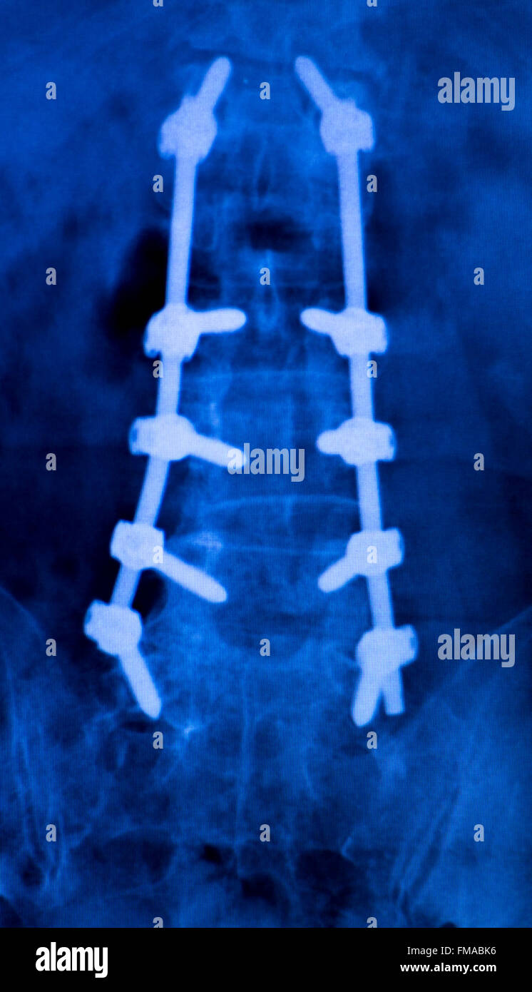 Implant de colonne vertébrale Banque de photographies et d'images à haute  résolution - Alamy