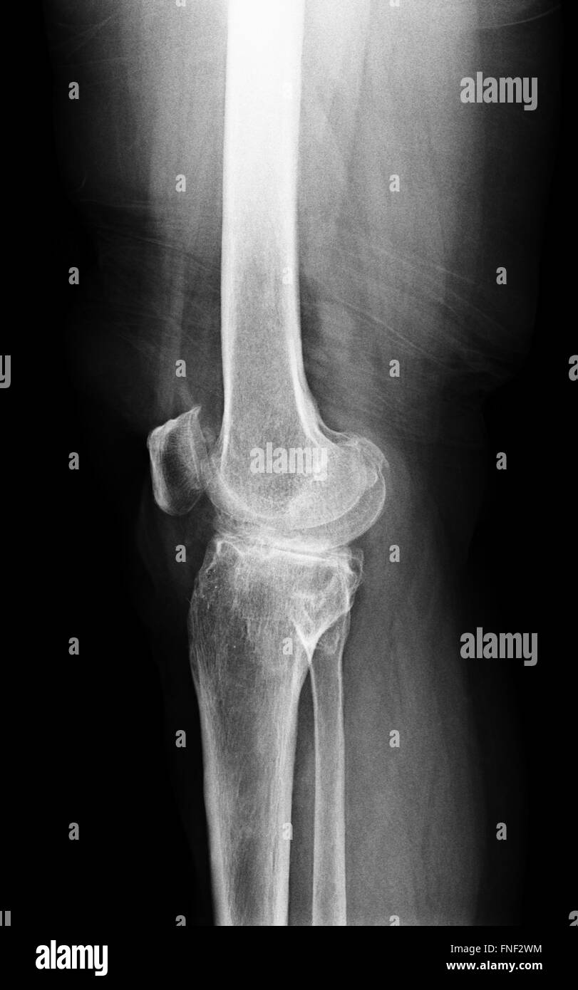 Remplacement total du genou avec x-ray image sur fond noir Banque D'Images