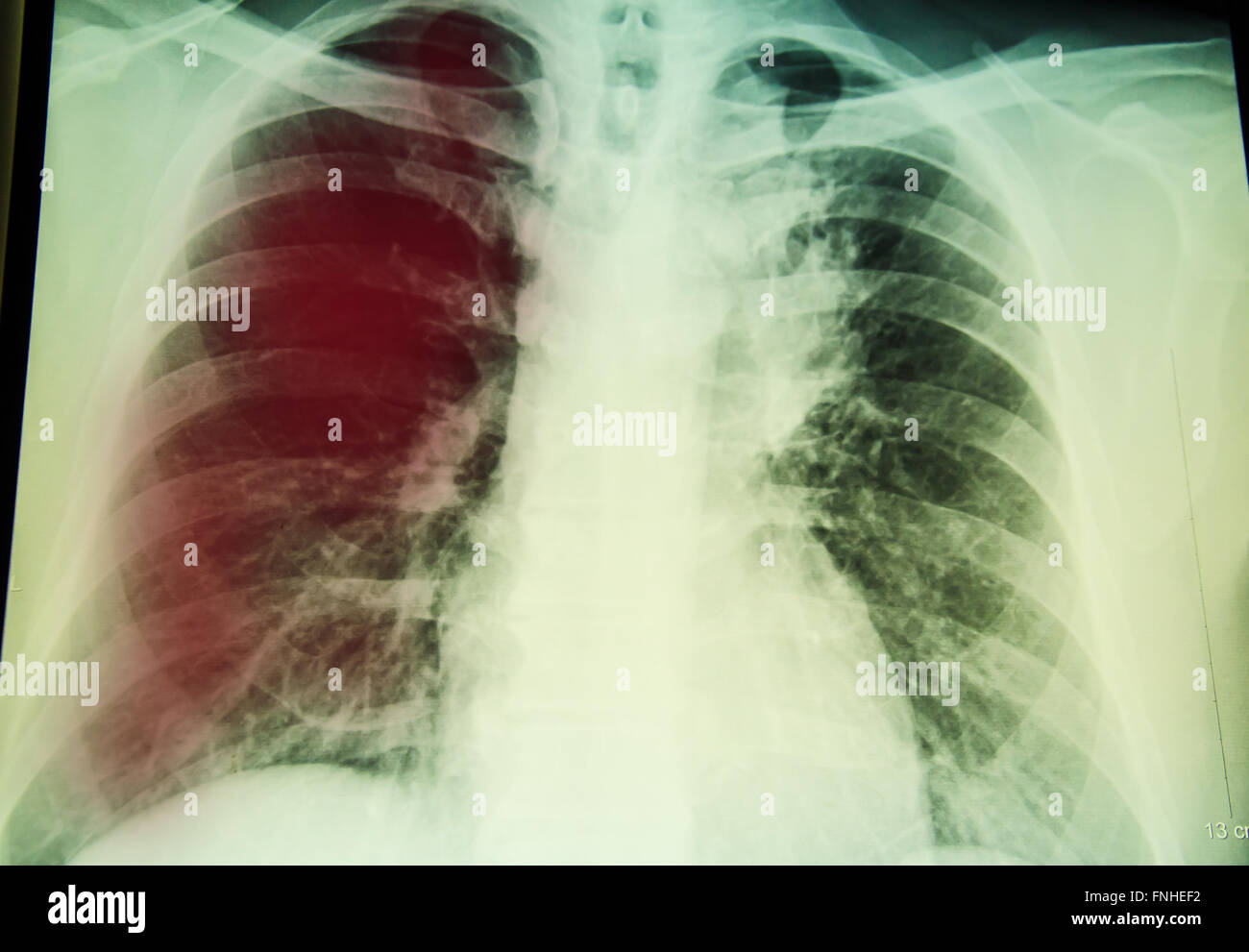 Radiographie de l'examen pour le diagnostic de tuberculose pulmonaire avec poumon droit Banque D'Images