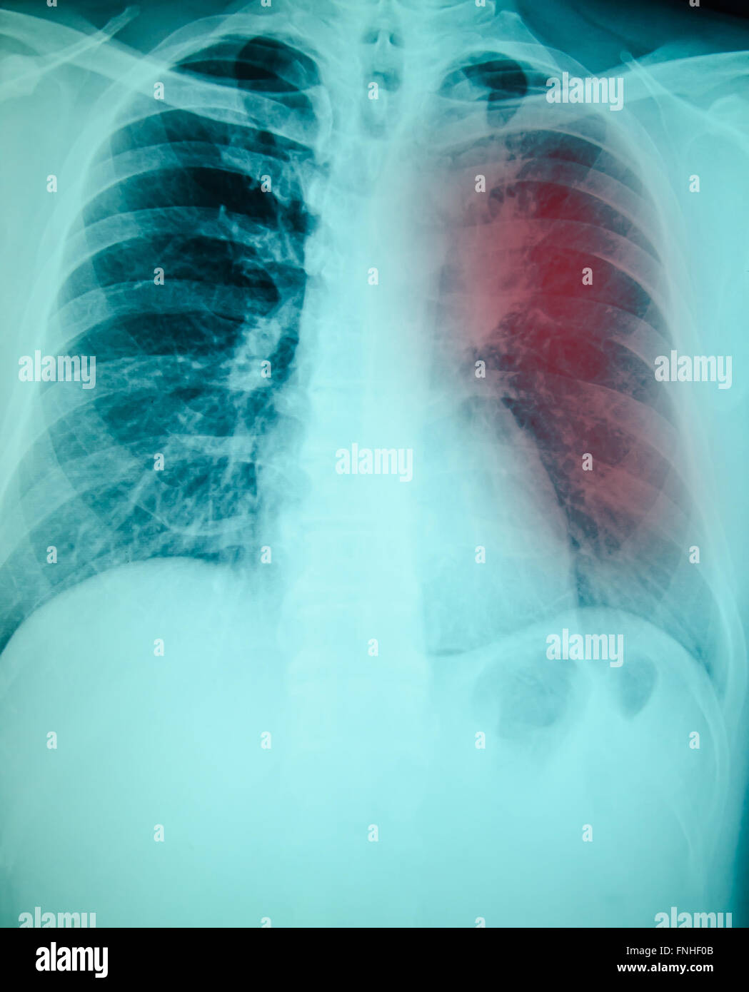 Radiographie de l'examen pour le diagnostic de tuberculose pulmonaire avec poumon gauche Banque D'Images