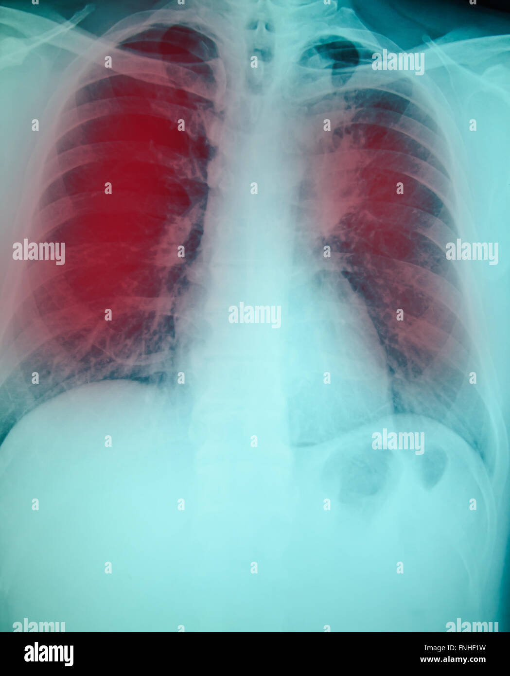 Radiographie de l'examen pour le diagnostic de tuberculose pulmonaire avec les deux poumons Banque D'Images