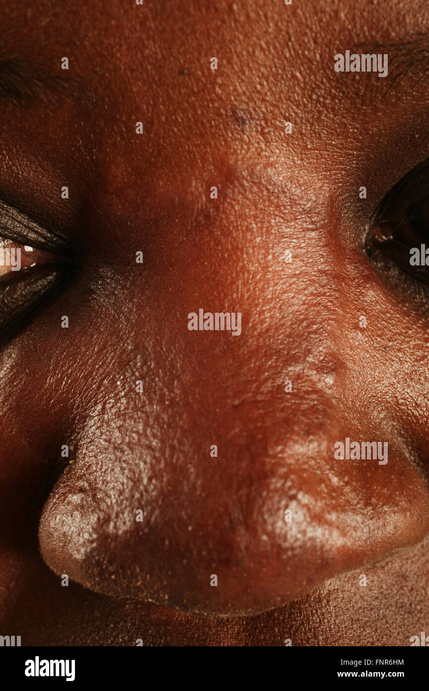 Close up du nez d'une femme de 40 ans souffrant de la lèpre paucibacillaire. La lèpre est une maladie apparaissant comme des lésions de la peau Banque D'Images