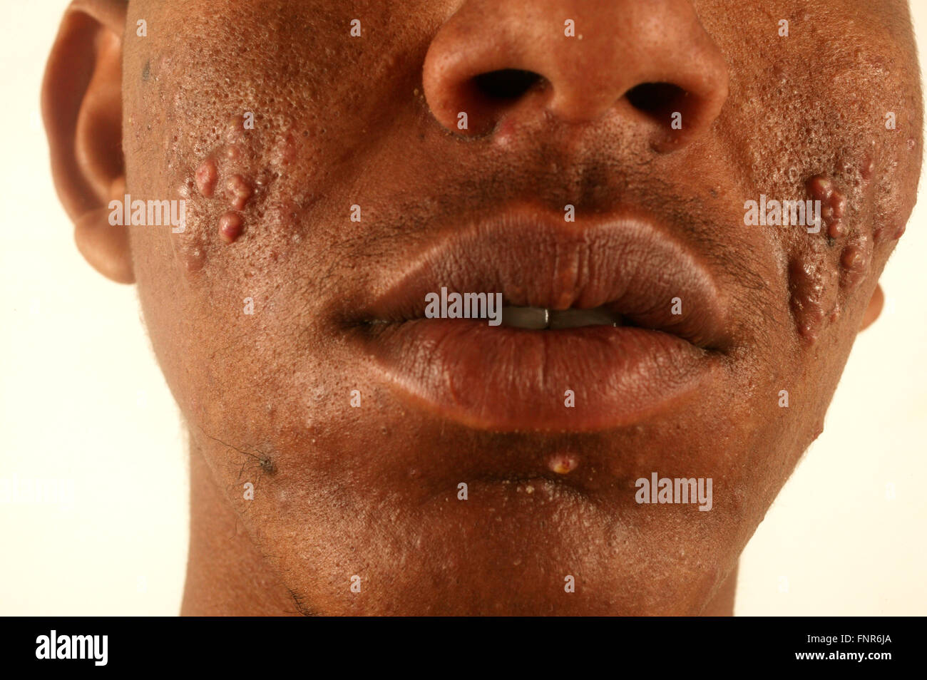 Vue de la moitié inférieure du visage d'un homme de 21 ans souffrant d'acné vulgaris. L'Acné est une affection cutanée qui est causé b Banque D'Images