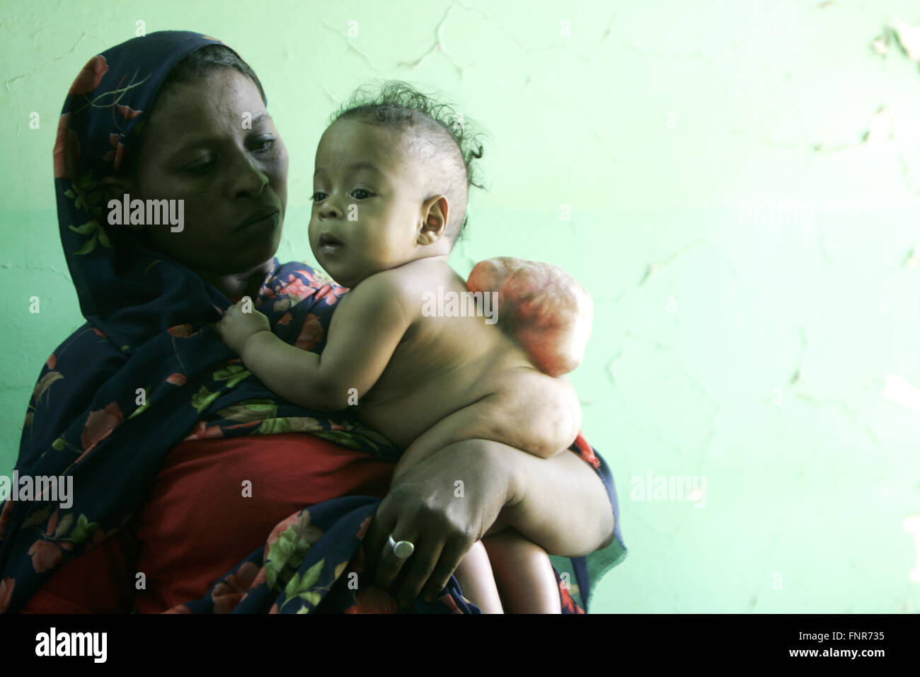 Une mère tient son bébé âgé de 5 mois qui a été né avec meningomyocele (tumeur congénitale de la moelle épinière). Banque D'Images