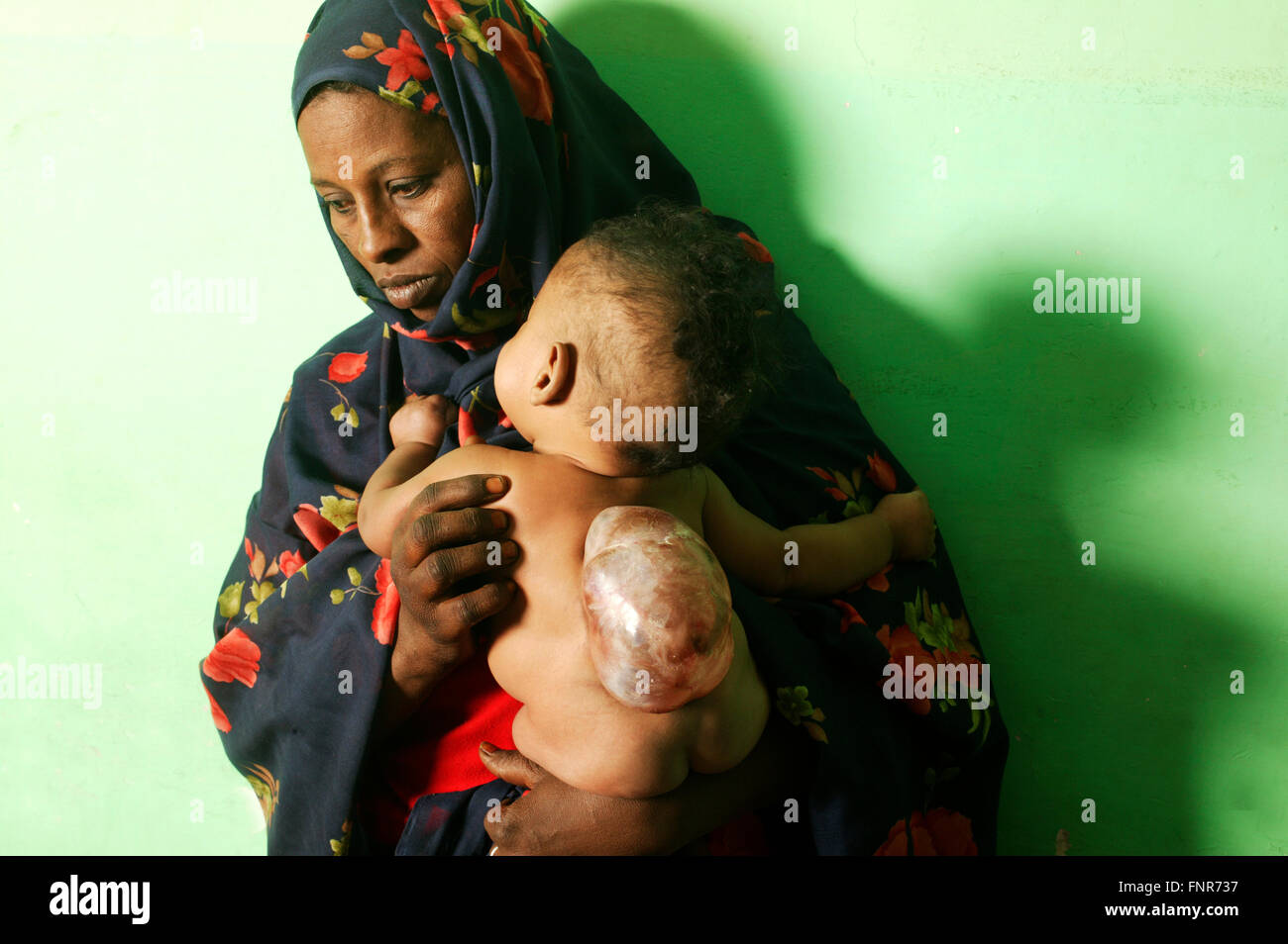 Une mère tient son bébé âgé de 5 mois, né à meningomyocele (tumeur congénitale de la moelle épinière). Banque D'Images