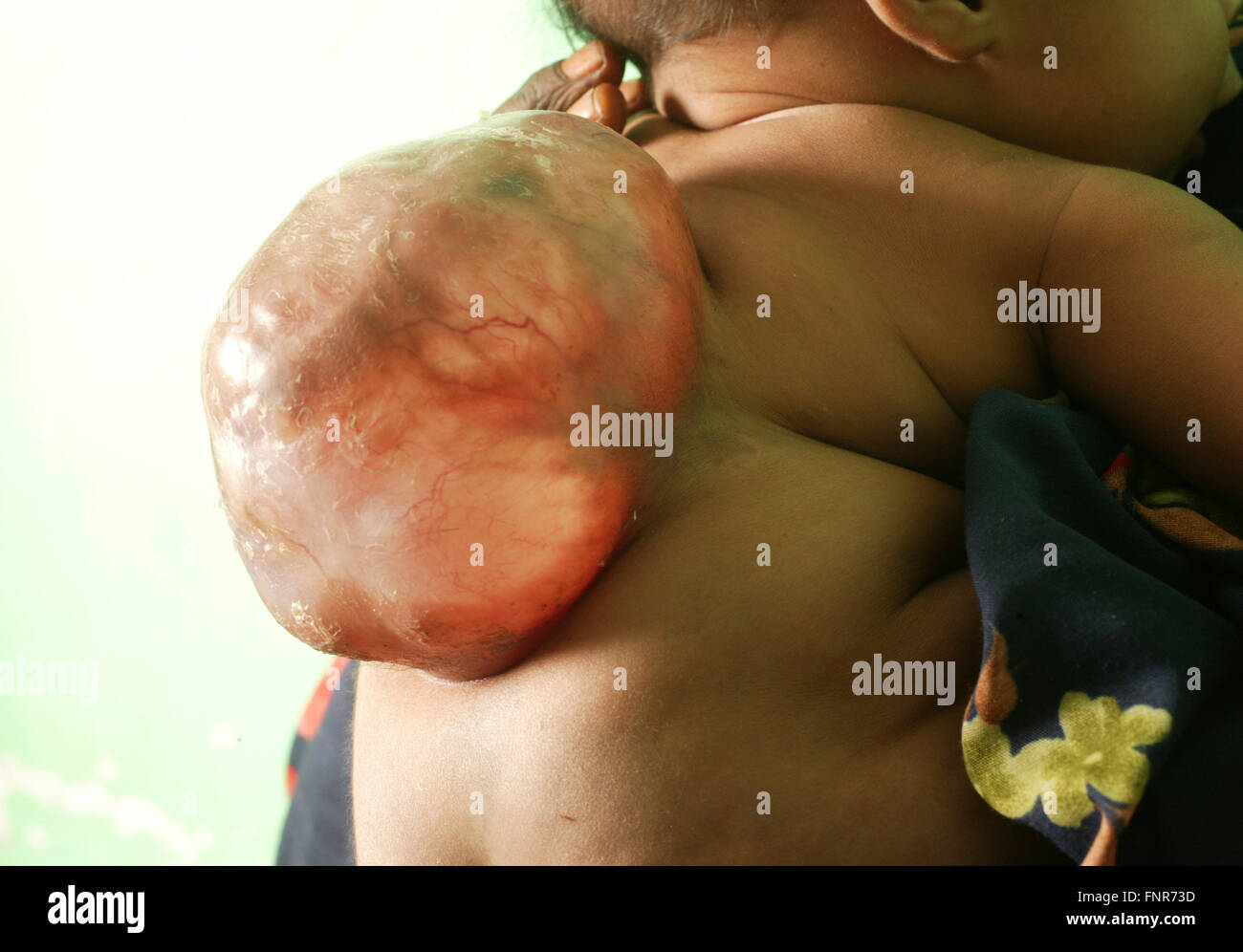 De près de l'arrière d'un bébé âgé de 5 mois né avec meningomyocele (tumeur congénitale de la moelle épinière). Banque D'Images