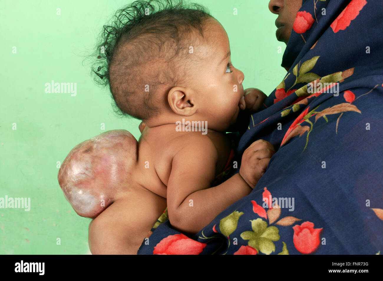 Une mère tient son bébé âgé de 5 mois né avec Meningomyocele (tumeur congénitale de la moelle épinière). Banque D'Images