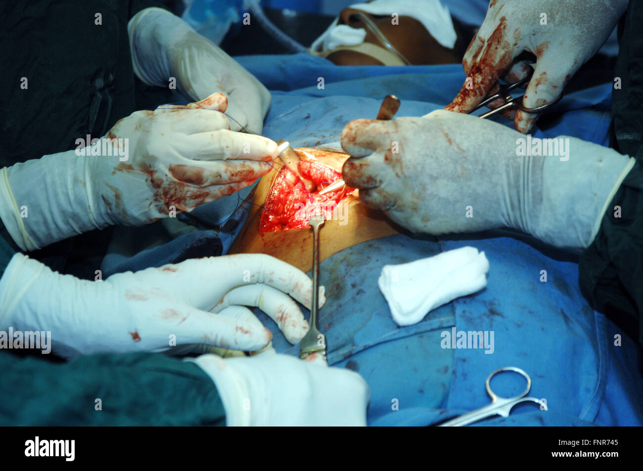 Gros plan sur les mains gantées opérant sur l'abdomen d'un patient. Banque D'Images