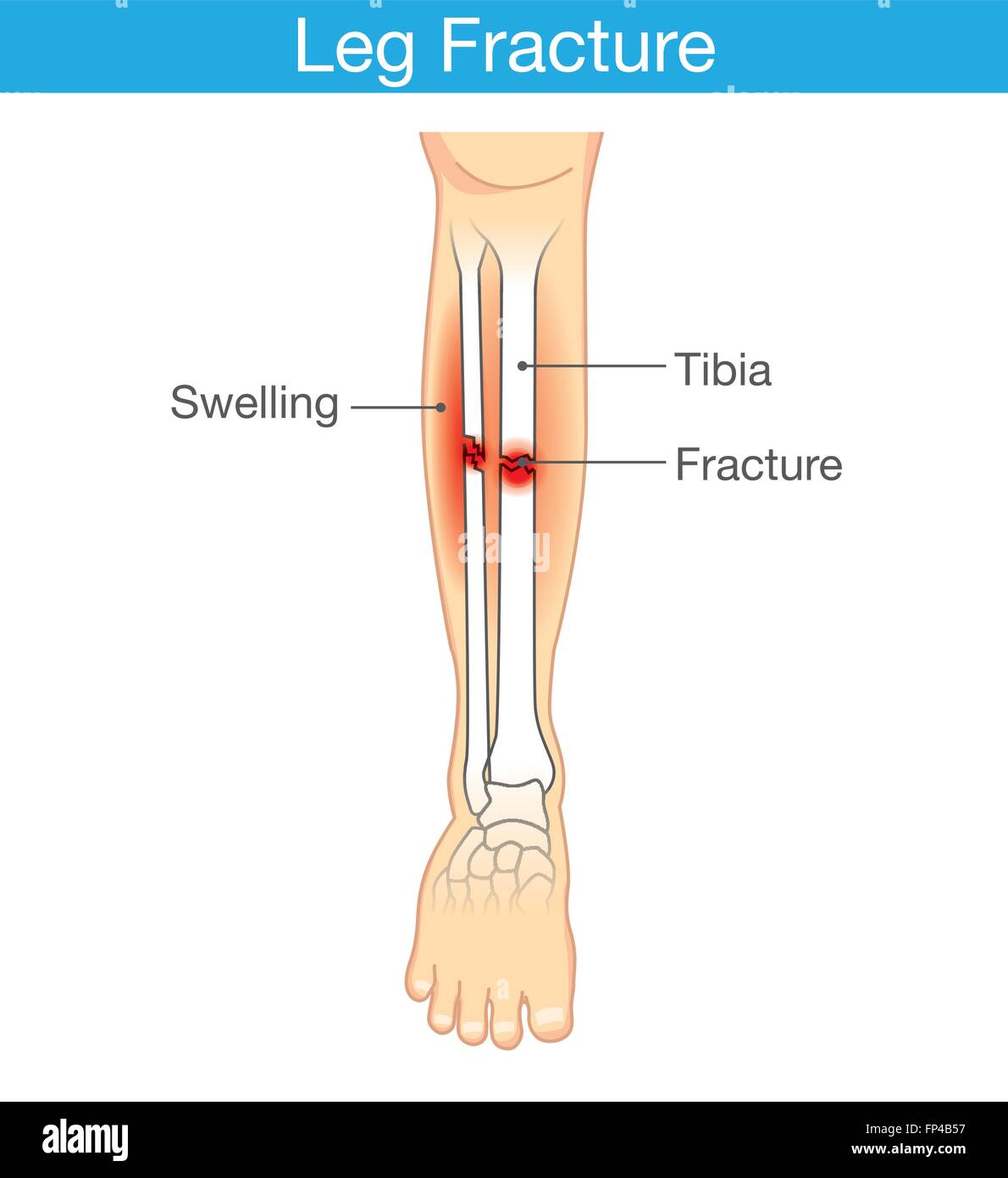 Diagramme d'une fracture de jambe Illustration de Vecteur