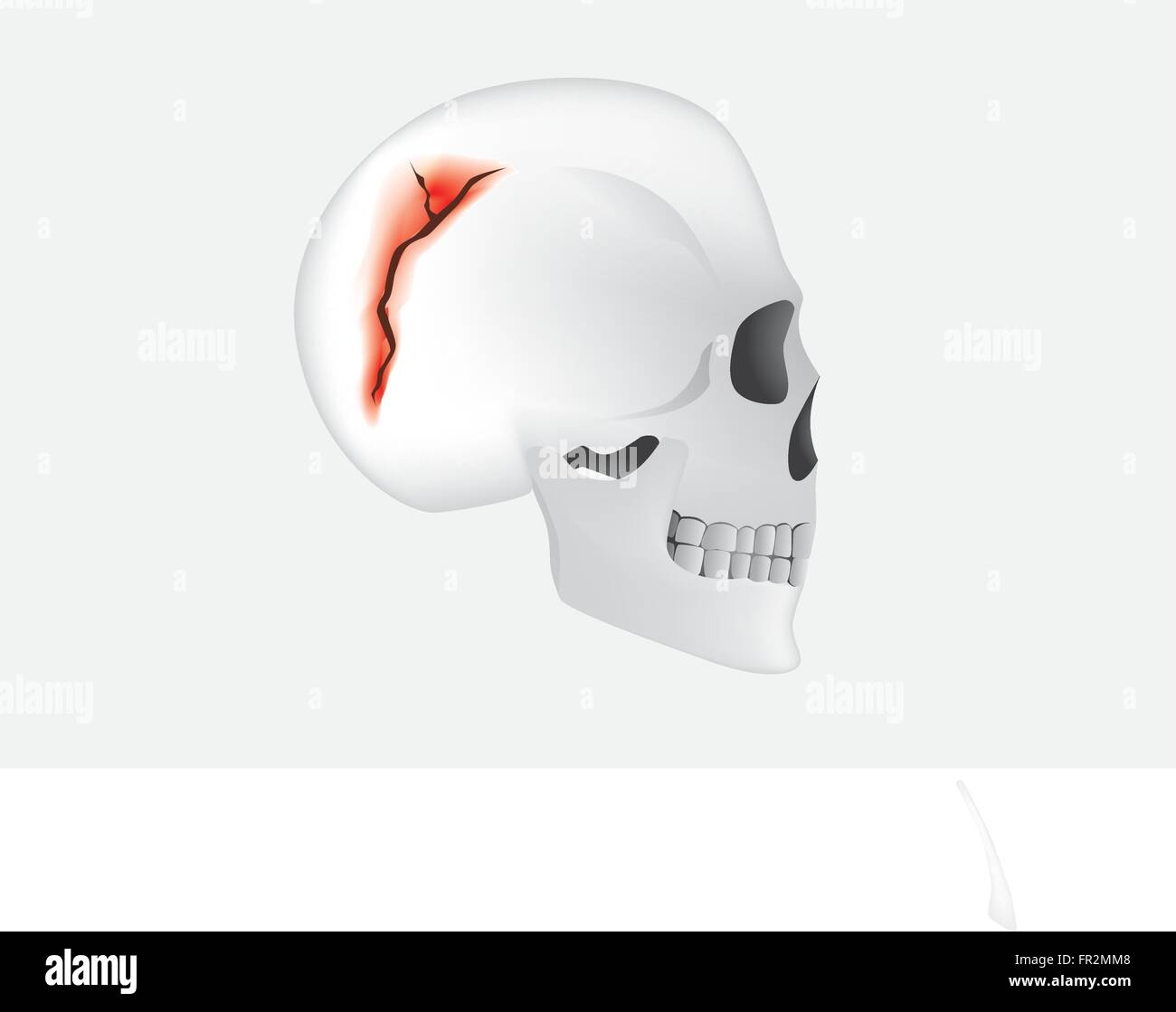 Fracture du crâne en vue de côté Image Vectorielle Stock - Alamy