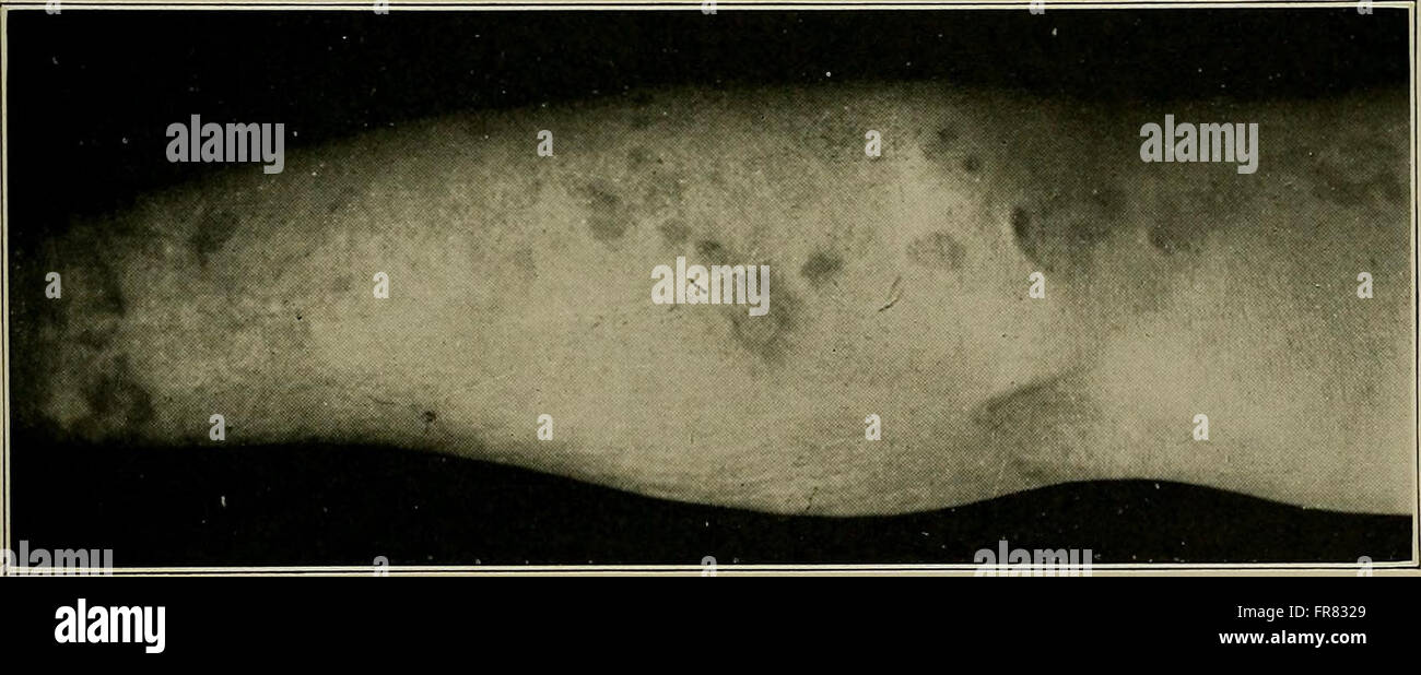 Ce traité de 1921 propose une analyse médicale détaillée de la syphilis, couvrant ses causes, symptômes, diagnostic, méthodes de traitement, et les stratégies de prévention, faisant autorité pour les professionnels de la santé. Banque D'Images