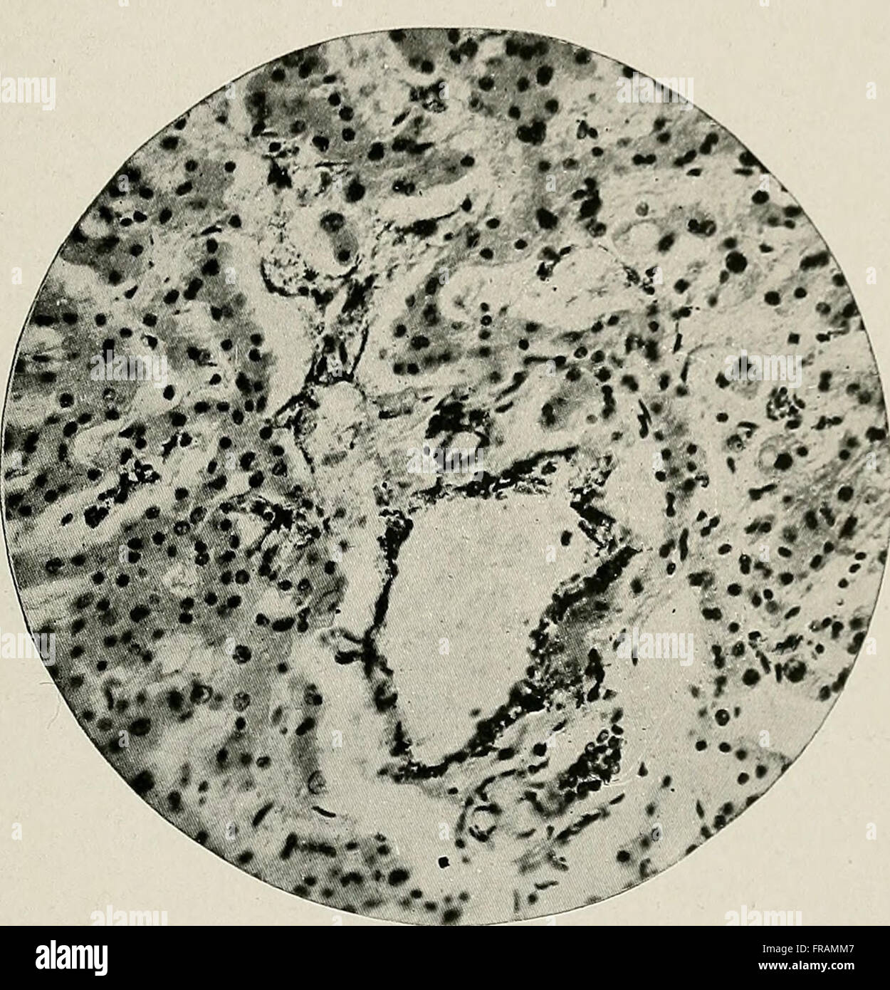 Coller dans les suppurations chroniques de bismuth, son importance diagnostique et thérapeutique (1910) Banque D'Images