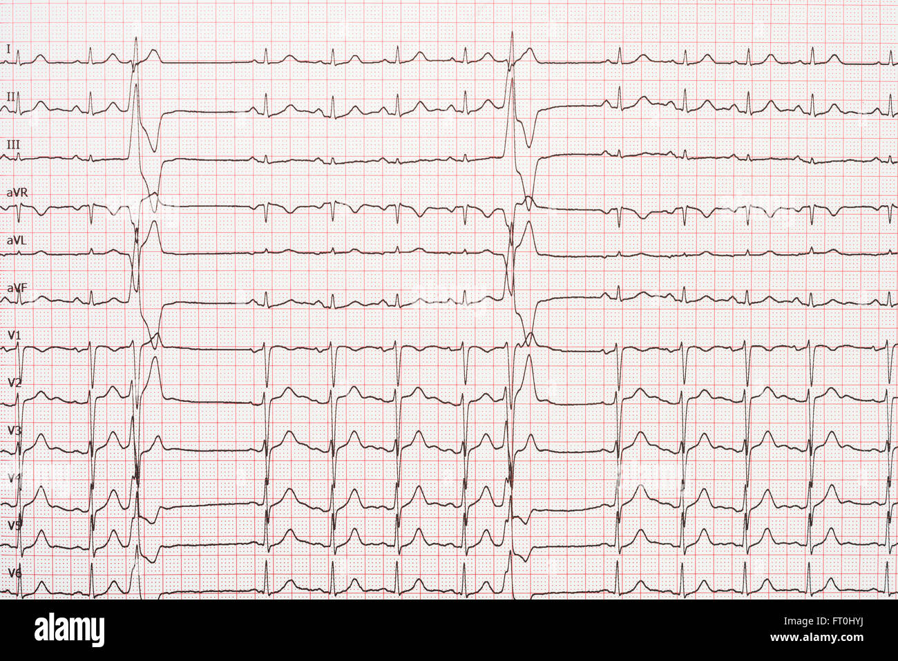 Extrasystole sur l'enregistrement de l'électrocardiogramme 12 dérivations Paper Banque D'Images