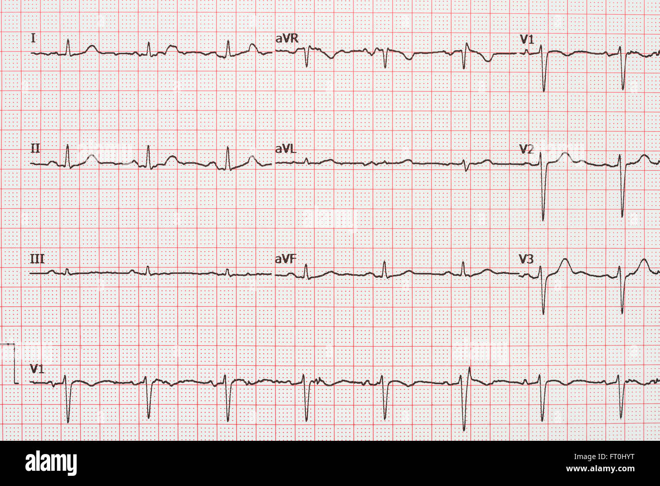 Extrasystole sur l'enregistrement de l'électrocardiogramme 12 dérivations Paper Banque D'Images