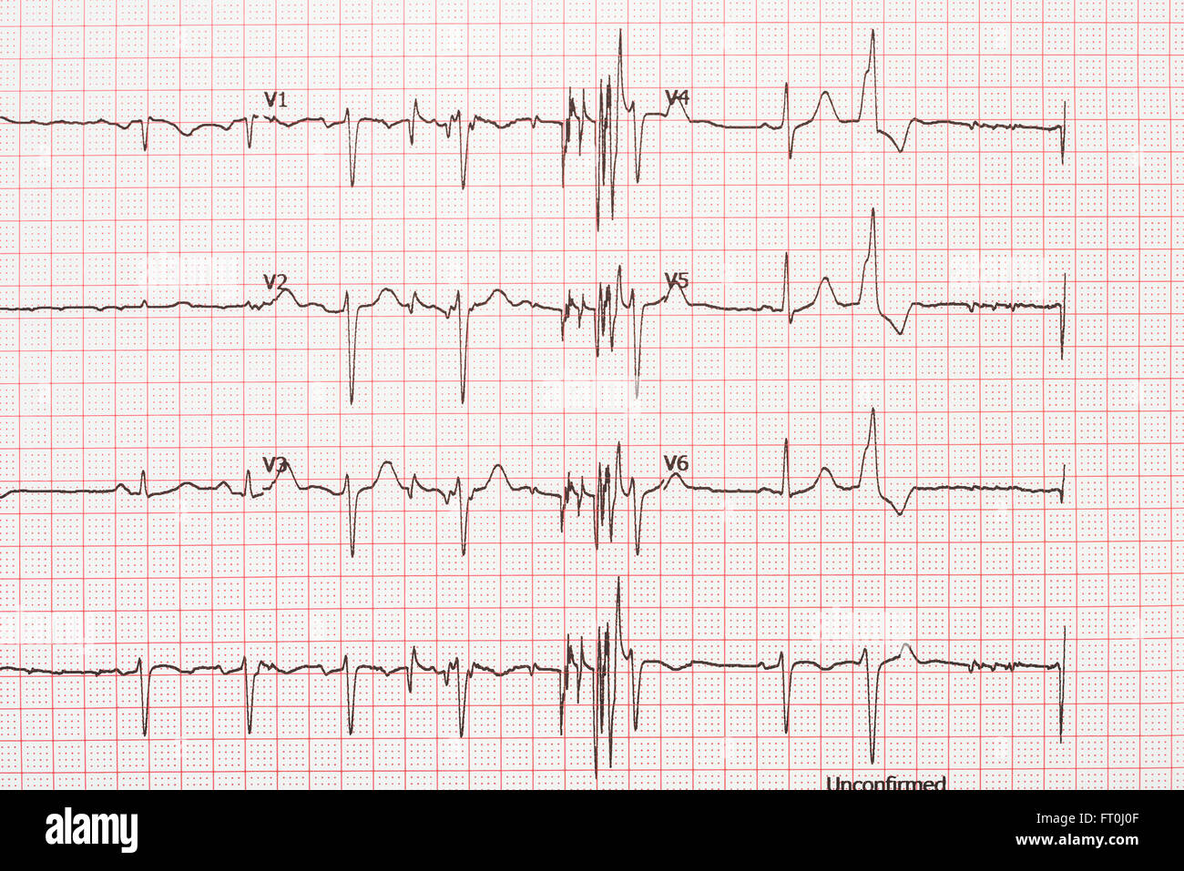 Extrasystole sur l'enregistrement de l'électrocardiogramme 12 dérivations Paper Banque D'Images