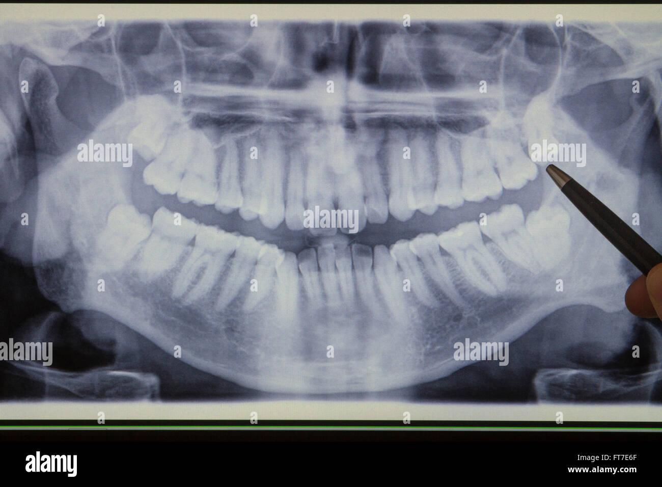 Pen indiquant une dent de sagesse sur une radiographie dentaire panoramique Banque D'Images