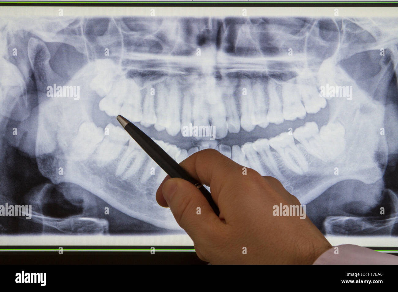 Main pointant une molaire sur une radiographie dentaire panoramique Banque D'Images
