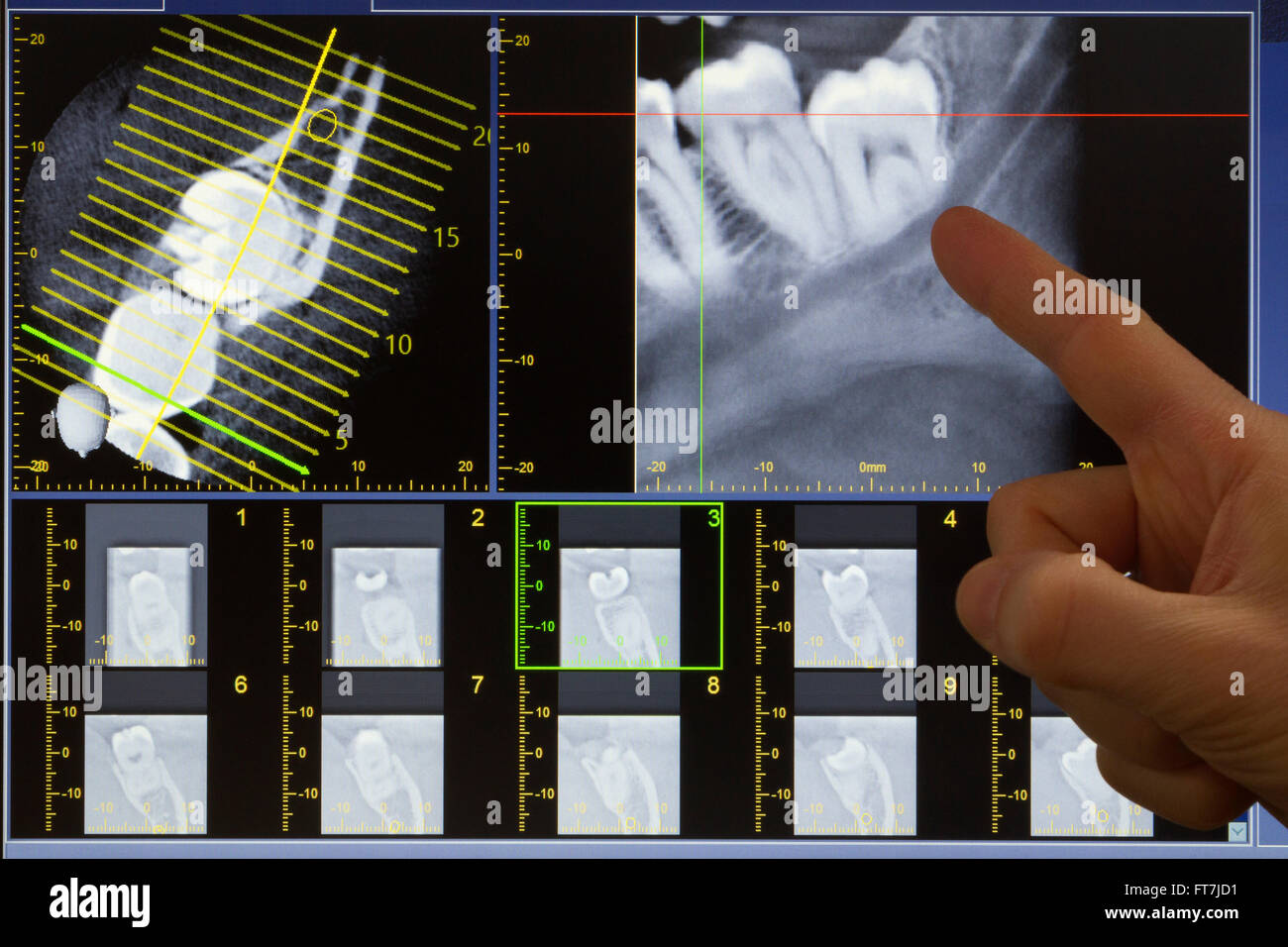 Médecin indiquant une dent de sagesse sur X-ray computed tomography Banque D'Images