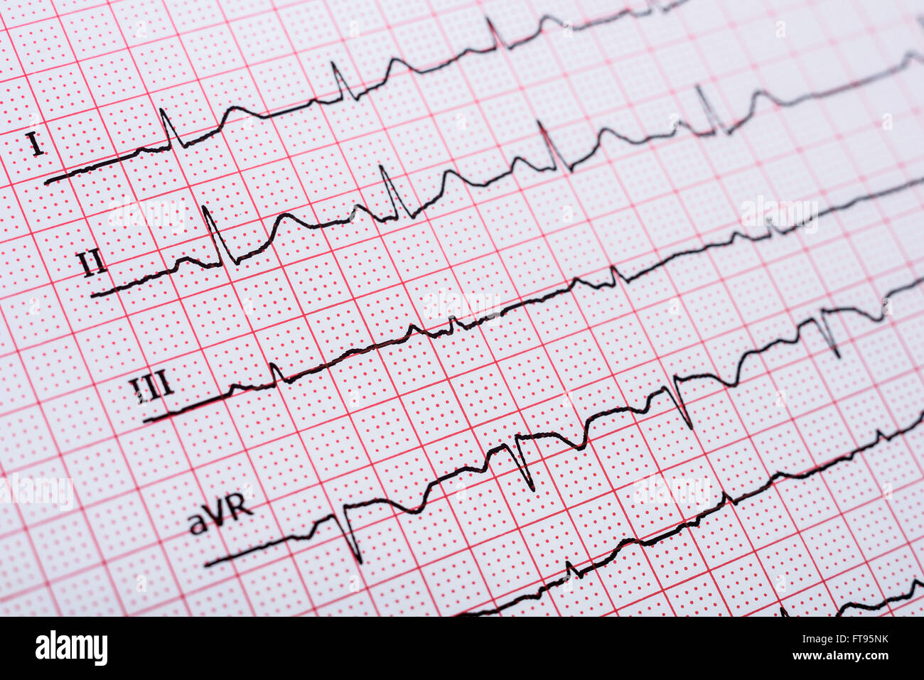 Normal ecg Banque de photographies et d’images à haute résolution - Alamy