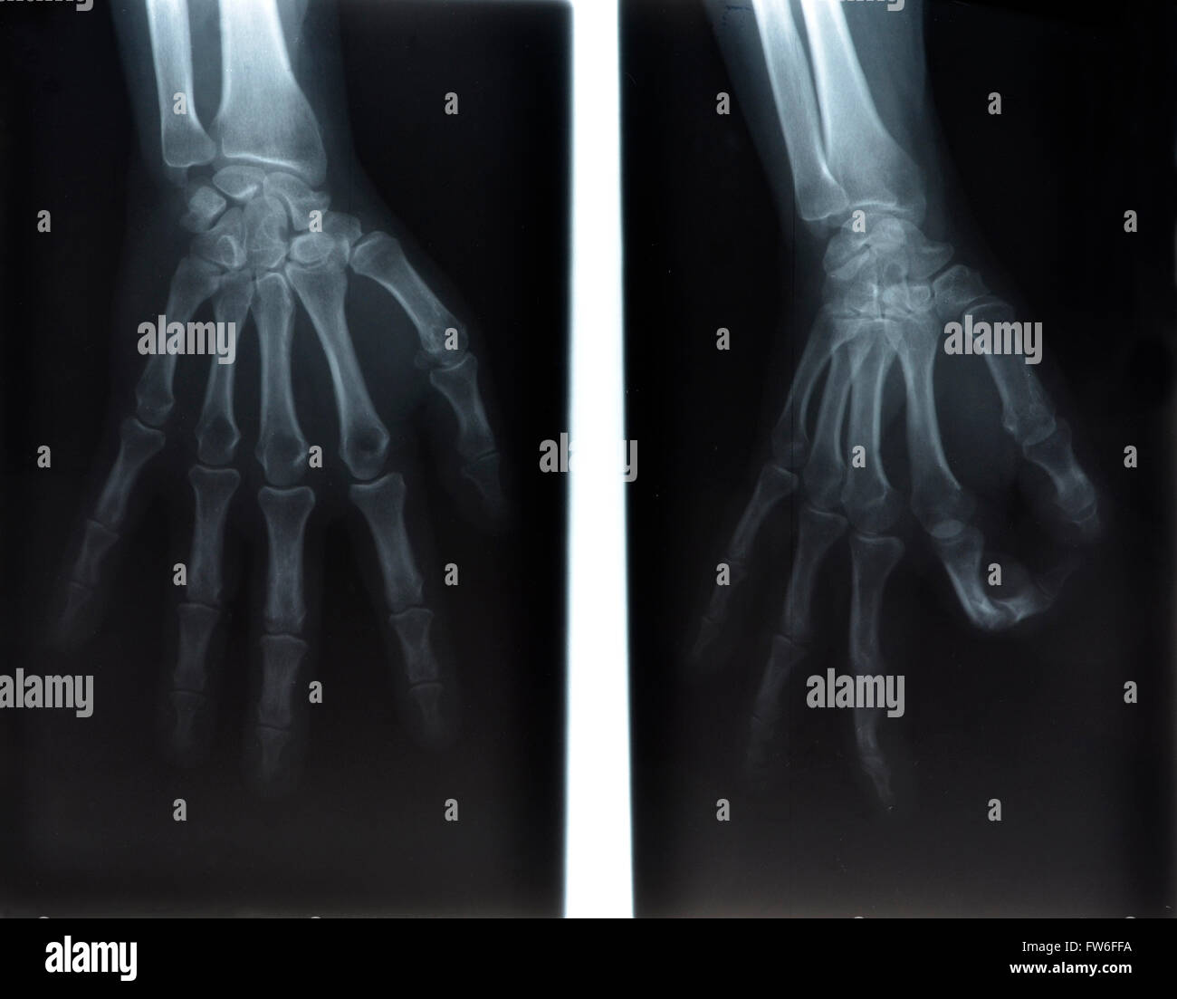 Radiographie de la main de l'homme Banque D'Images