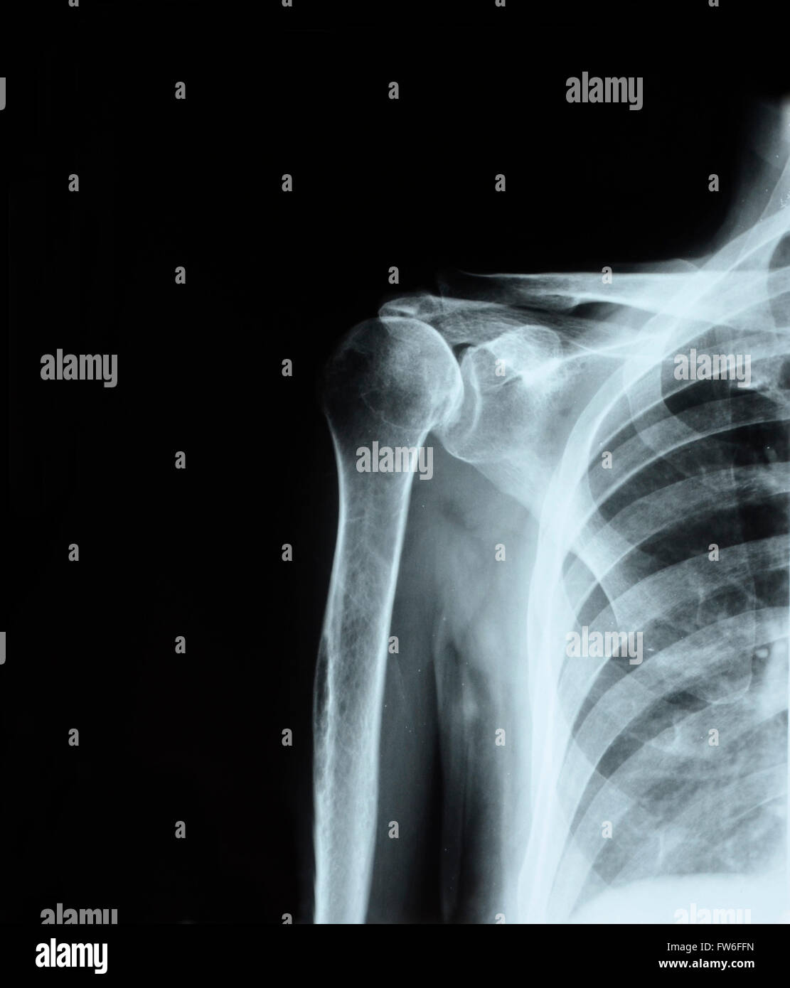 X-ray de l'articulation de l'épaule Banque D'Images