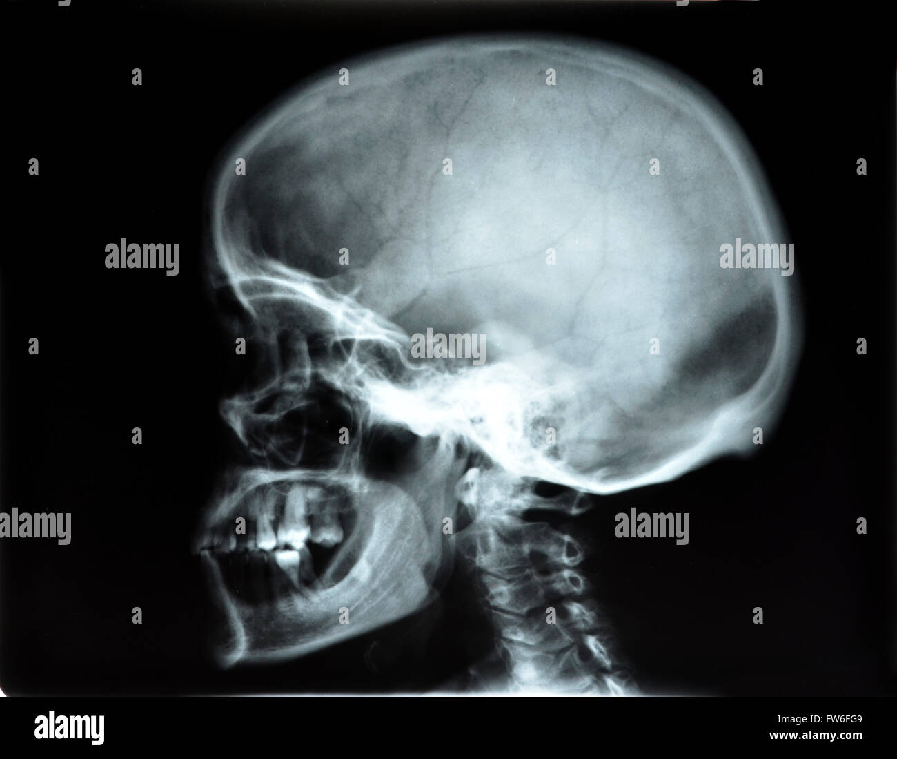 Les radiographies du crâne de droit plan sagittal Banque D'Images