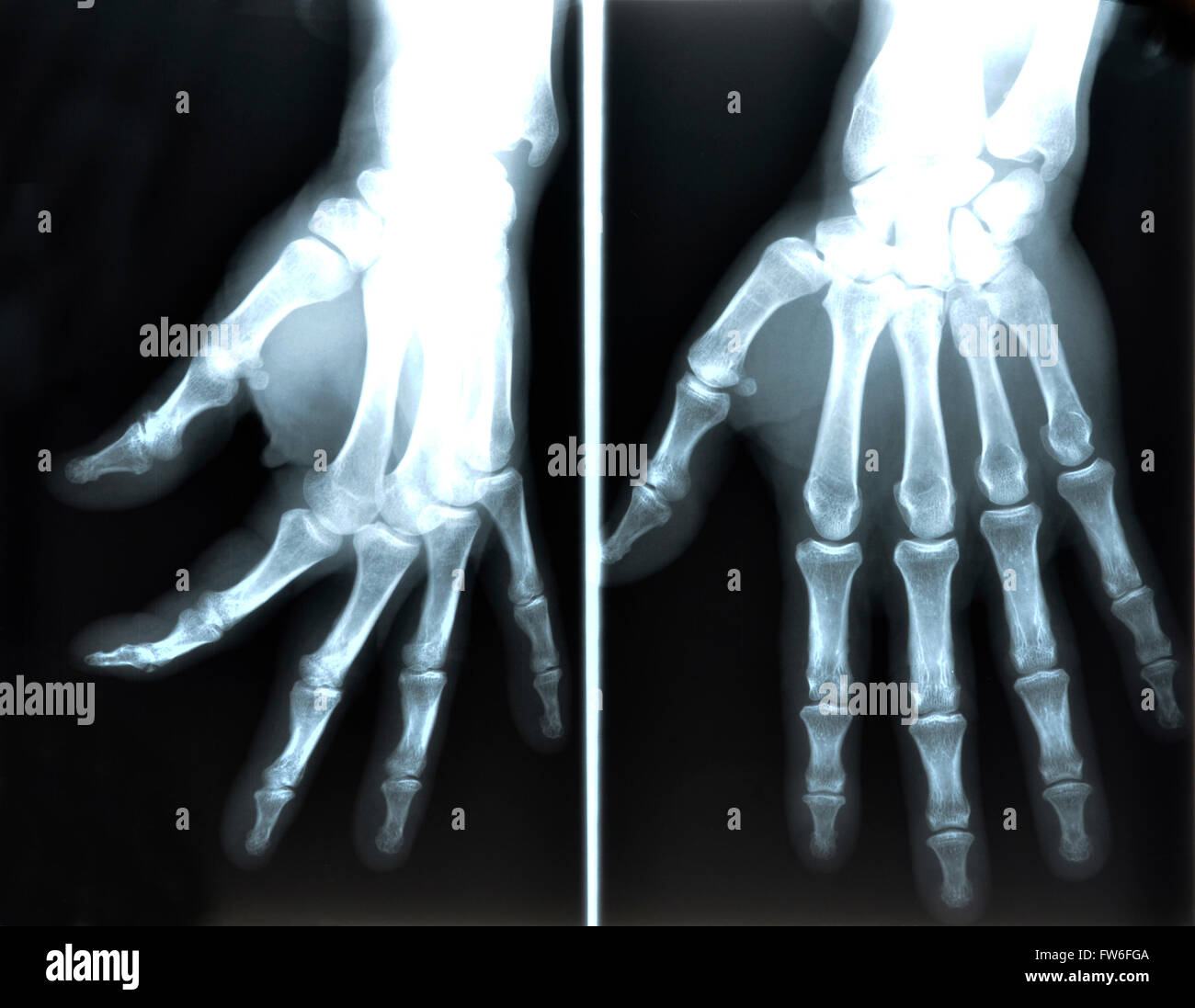 Radiographie de la main de l'homme Banque D'Images