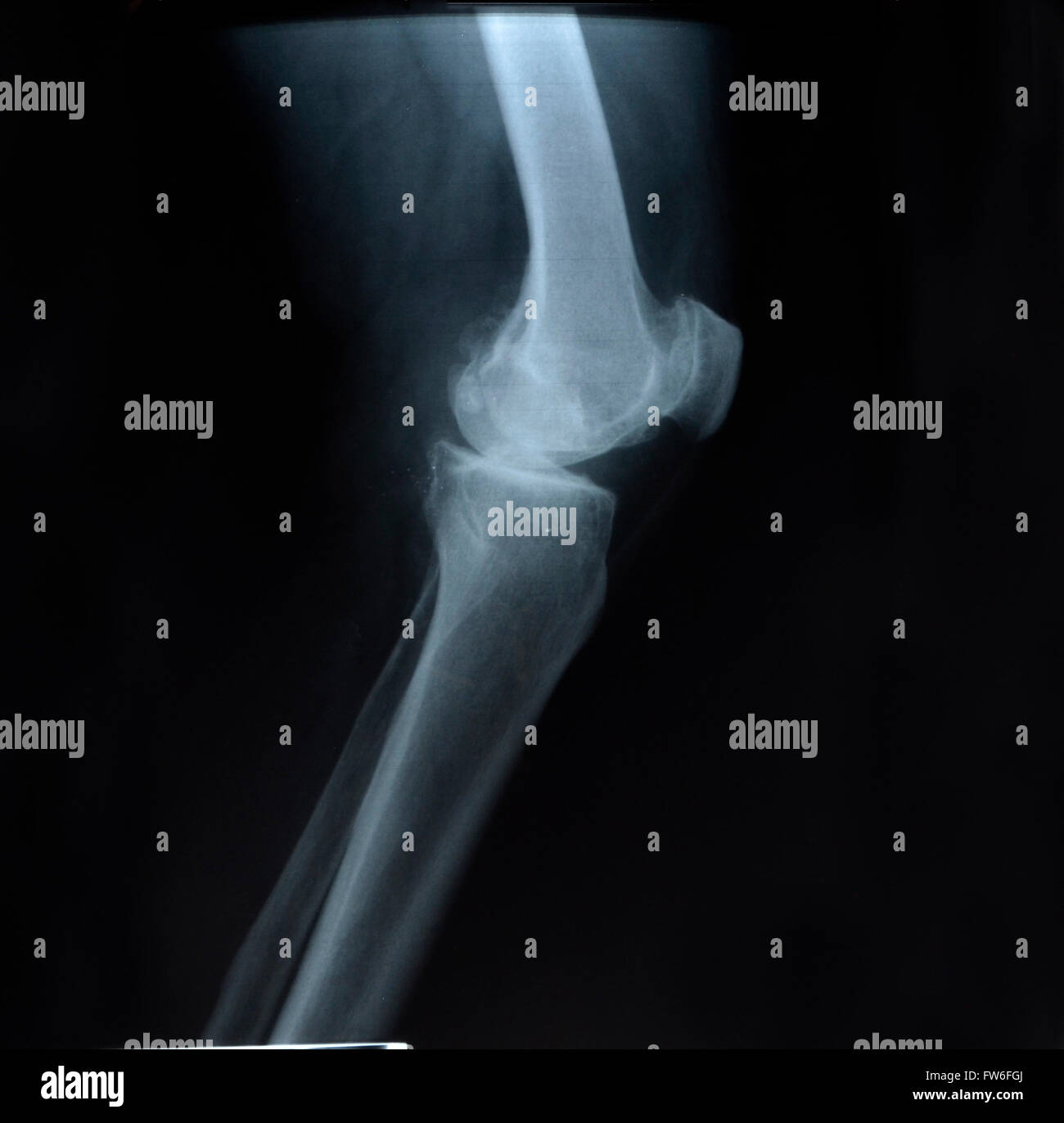 X-ray photo montrant le genou Banque D'Images
